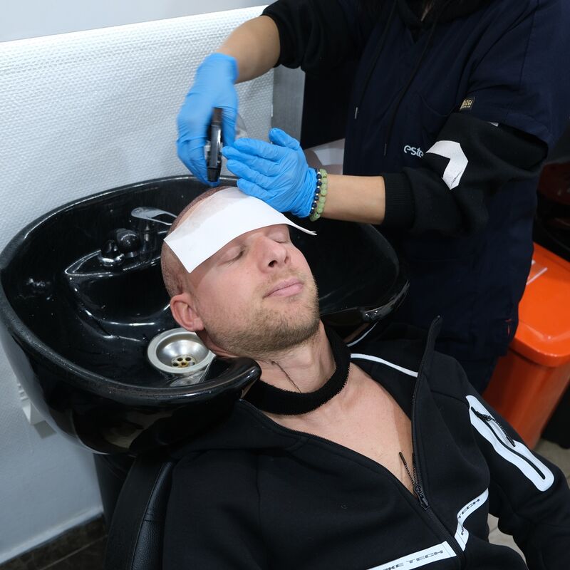 Teus, open en vertrouwelijke haartransplantatie intake in Nederland