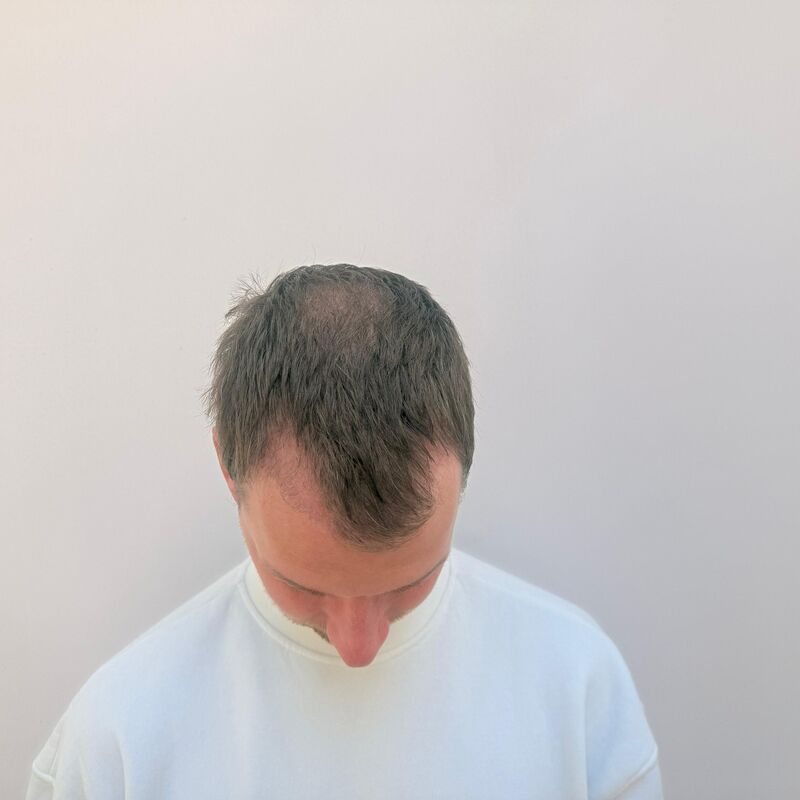 Teus, open en vertrouwelijke haartransplantatie intake in Nederland