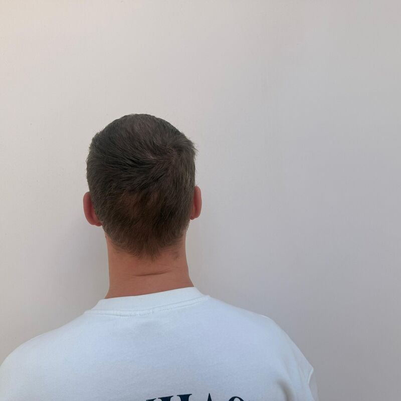 Teus, open en vertrouwelijke haartransplantatie intake in Nederland