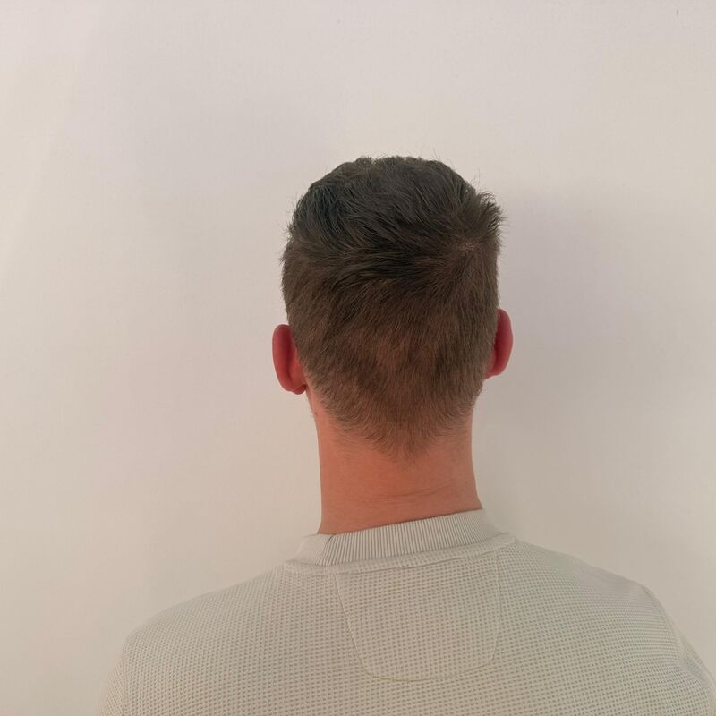 Teus, open en vertrouwelijke haartransplantatie intake in Nederland