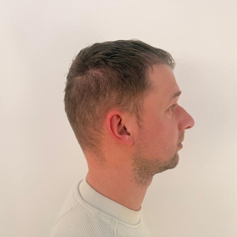 Teus, open en vertrouwelijke haartransplantatie intake in Nederland