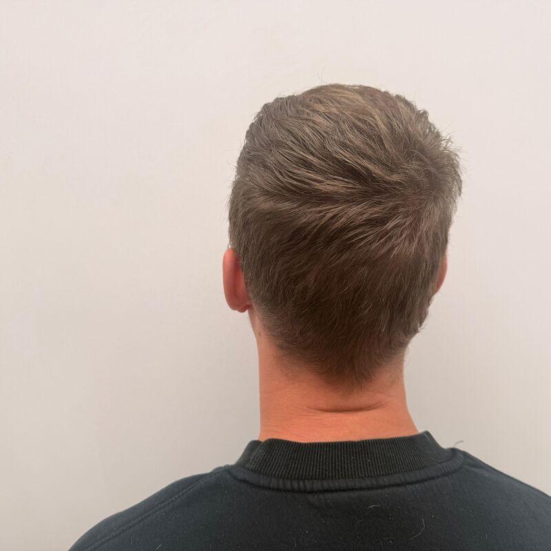 Teus, open en vertrouwelijke haartransplantatie intake in Nederland