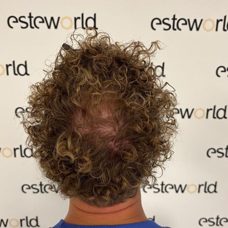 Teus, open en vertrouwelijke haartransplantatie intake in Nederland