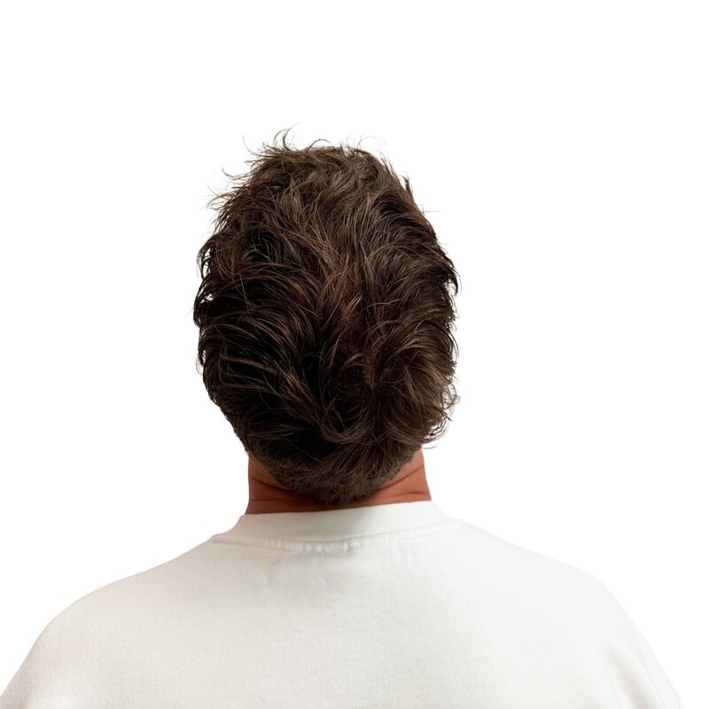 Teus, open en vertrouwelijke haartransplantatie intake in Nederland