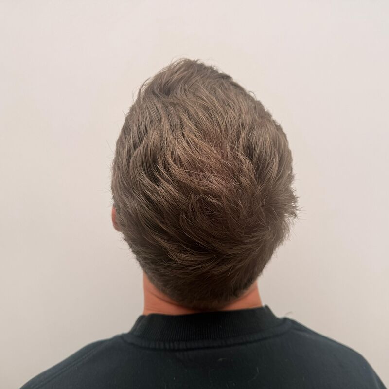 Teus, open en vertrouwelijke haartransplantatie intake in Nederland