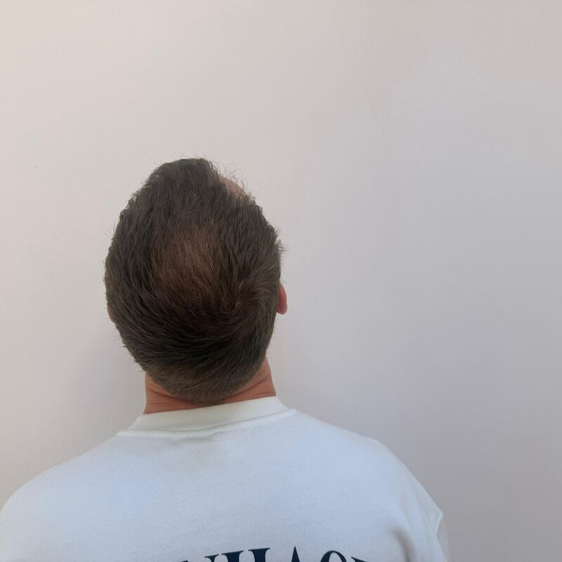 Teus, open en vertrouwelijke haartransplantatie intake in Nederland