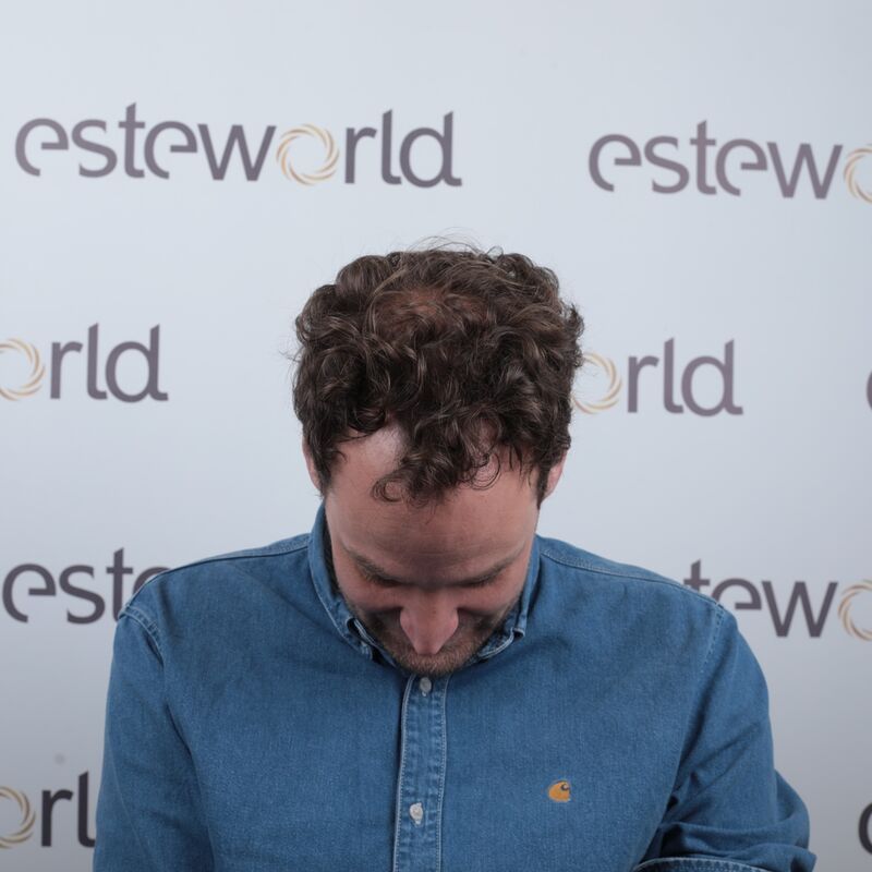 Mijn inhammen werden dieper en dieper. Tijd voor een haartransplantatie