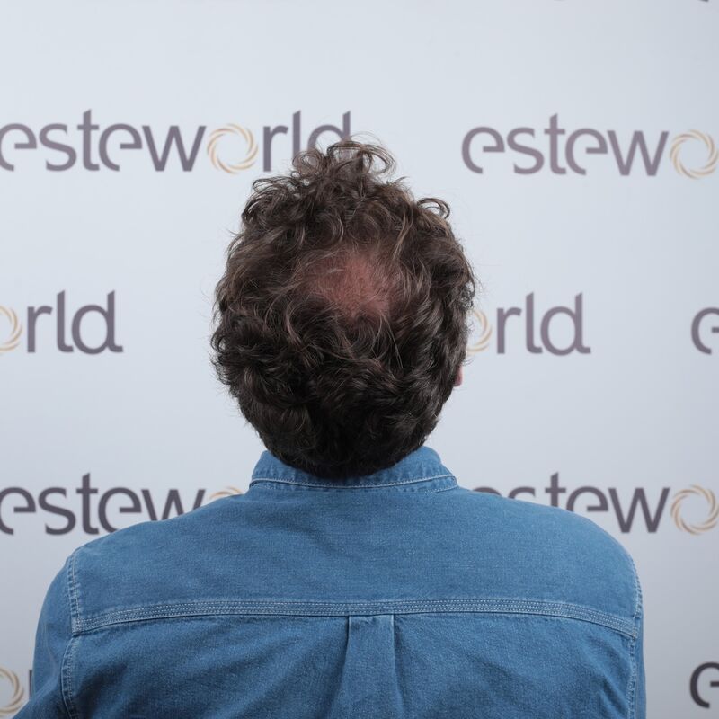 Mijn inhammen werden dieper en dieper. Tijd voor een haartransplantatie