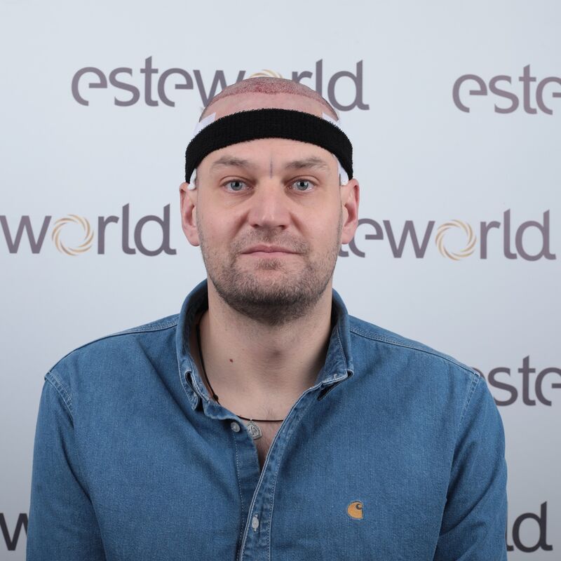 Mijn inhammen werden dieper en dieper. Tijd voor een haartransplantatie