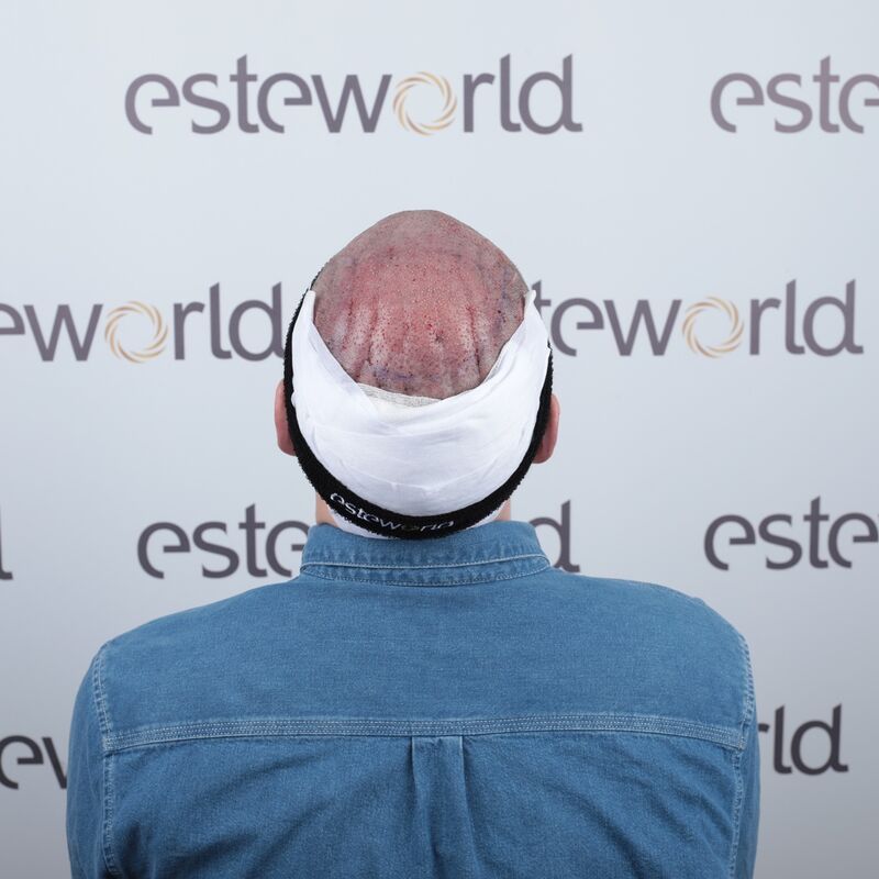 Mijn inhammen werden dieper en dieper. Tijd voor een haartransplantatie