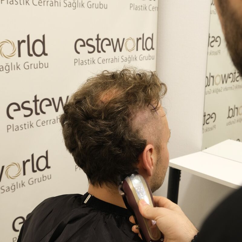 Mijn inhammen werden dieper en dieper. Tijd voor een haartransplantatie