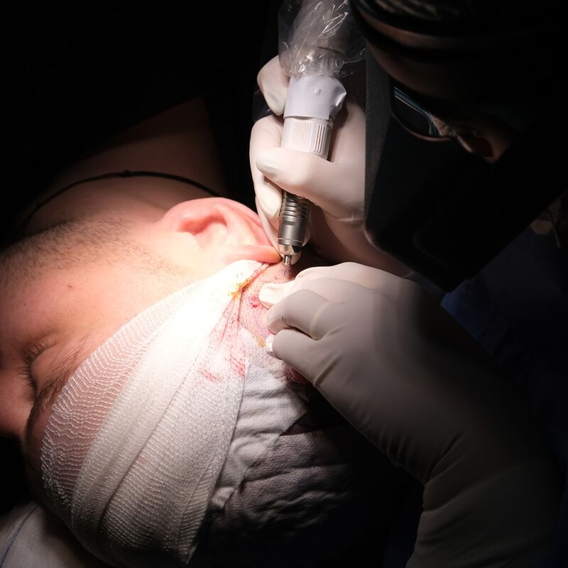 Mijn inhammen werden dieper en dieper. Tijd voor een haartransplantatie