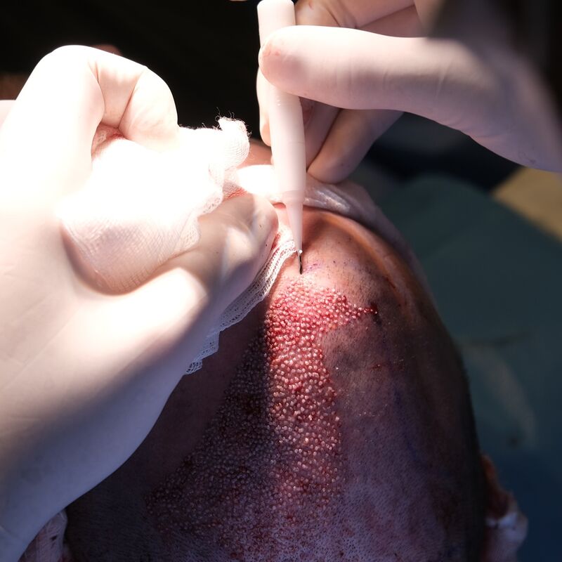 Mijn inhammen werden dieper en dieper. Tijd voor een haartransplantatie