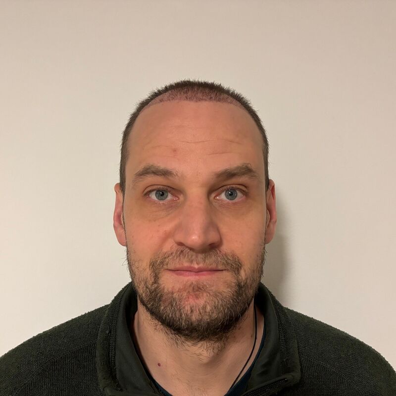 Mijn inhammen werden dieper en dieper. Tijd voor een haartransplantatie