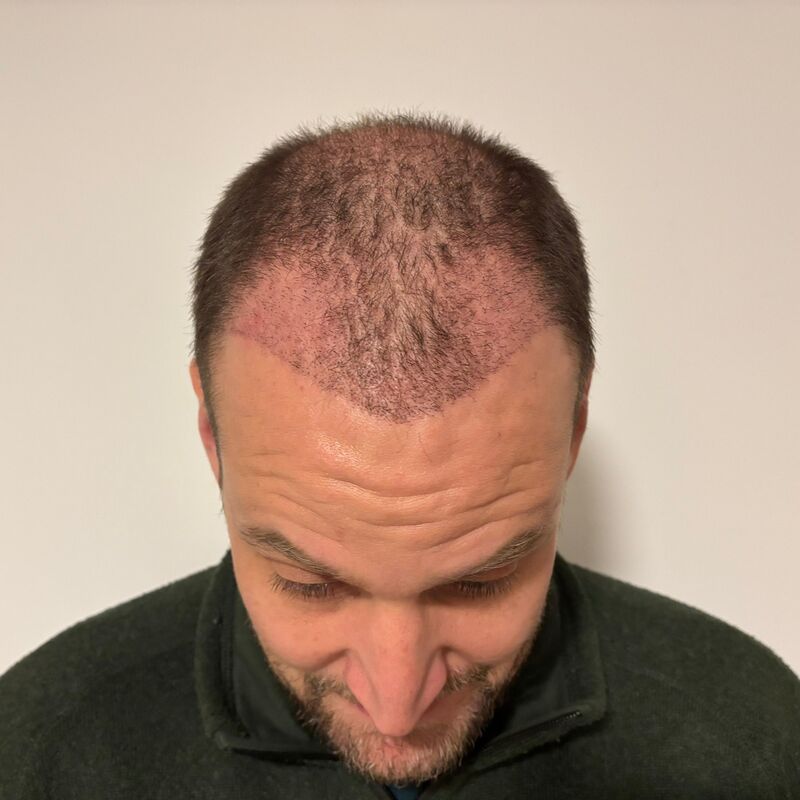 Mijn inhammen werden dieper en dieper. Tijd voor een haartransplantatie