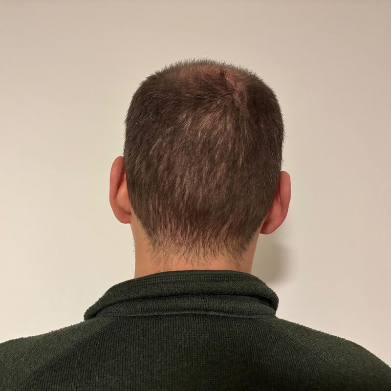 Mijn inhammen werden dieper en dieper. Tijd voor een haartransplantatie