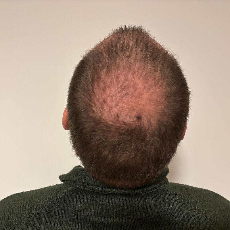 Mijn inhammen werden dieper en dieper. Tijd voor een haartransplantatie