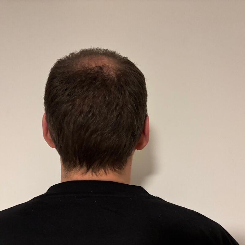 Mijn inhammen werden dieper en dieper. Tijd voor een haartransplantatie