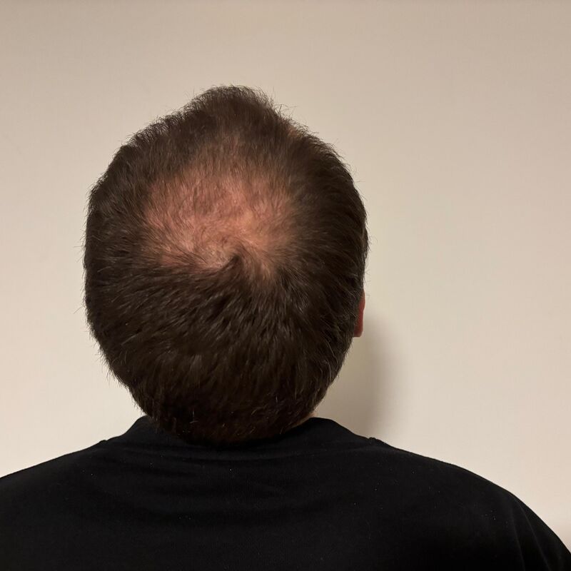 Mijn inhammen werden dieper en dieper. Tijd voor een haartransplantatie