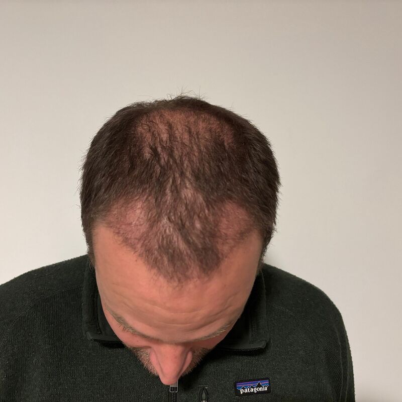 Mijn inhammen werden dieper en dieper. Tijd voor een haartransplantatie