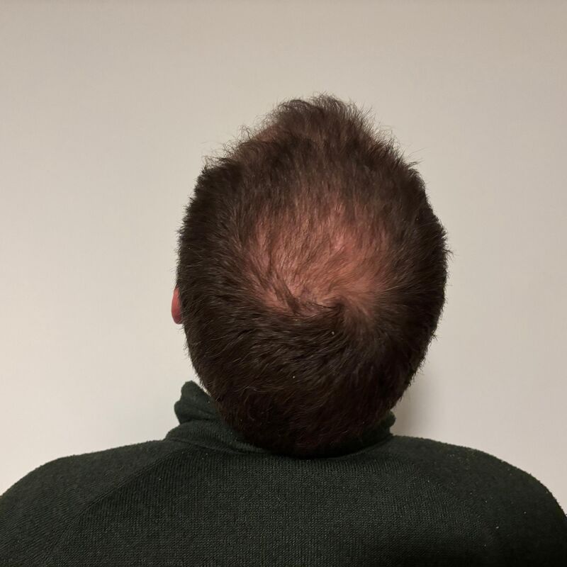 Mijn inhammen werden dieper en dieper. Tijd voor een haartransplantatie