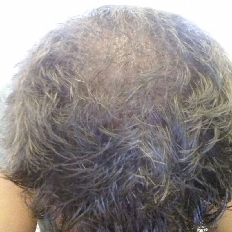 Yve, Goedkope haartransplantatie Turkije