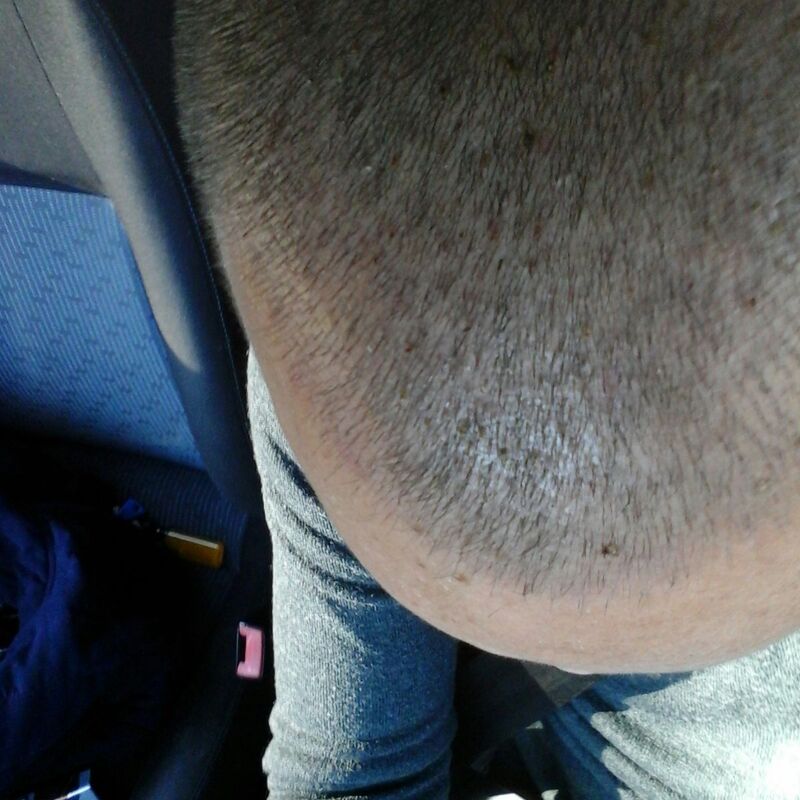 Yve, Goedkope haartransplantatie Turkije