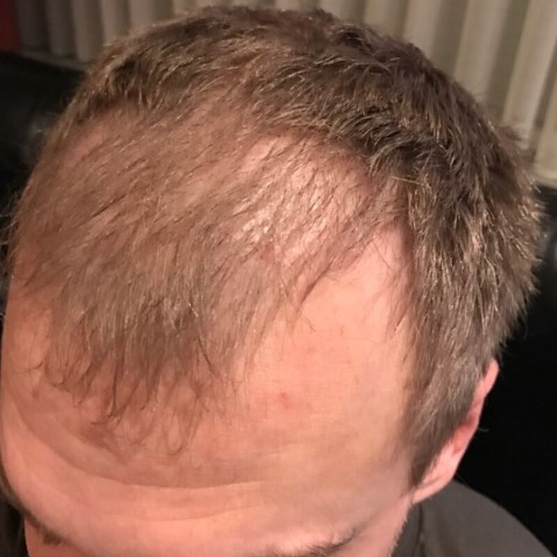 Naar Turkije voor een haartransplantatie! JA! Bij Esteworld haartransplantatie.