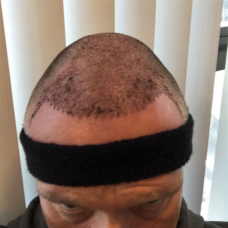 Nol, een 9 voor het hele proces van de haartransplantatie!