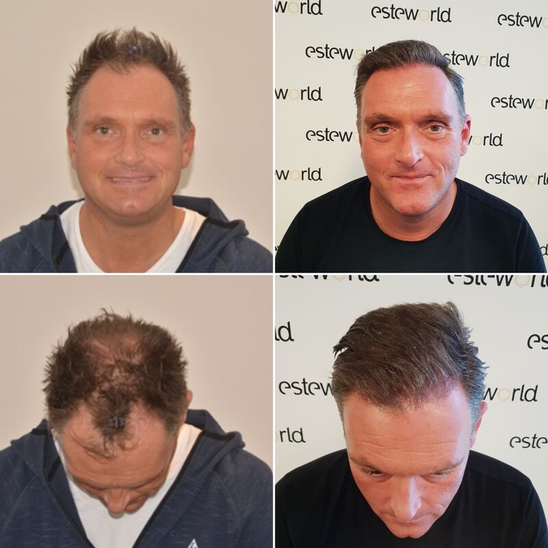 Nol, een 9 voor het hele proces van de haartransplantatie!