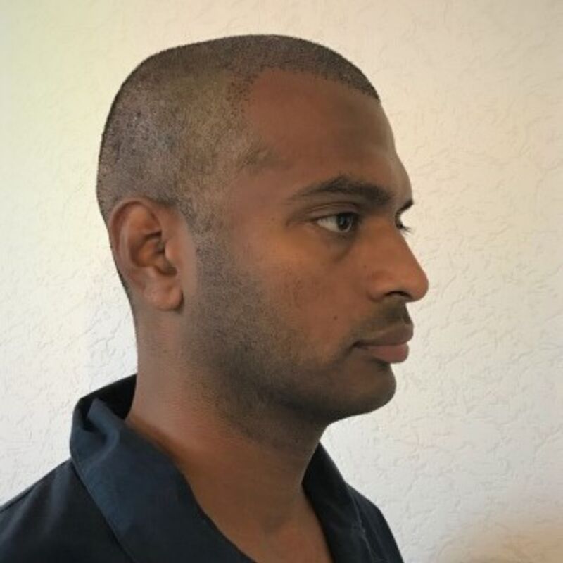 Kasan, 1/3de van kosten haartransplantatie in Nederland