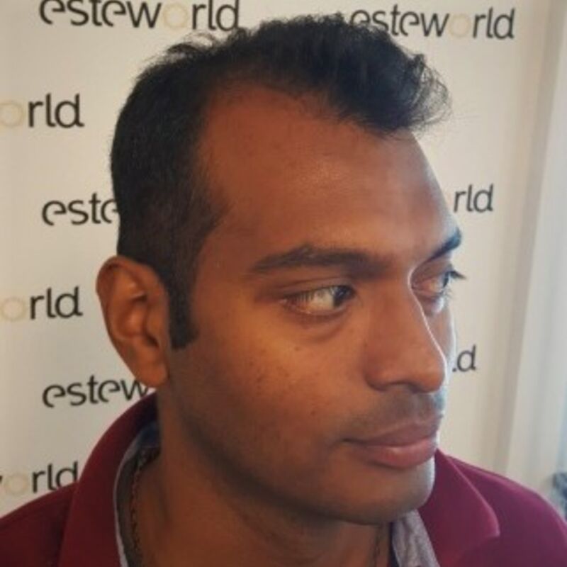 Kasan, 1/3de van kosten haartransplantatie in Nederland