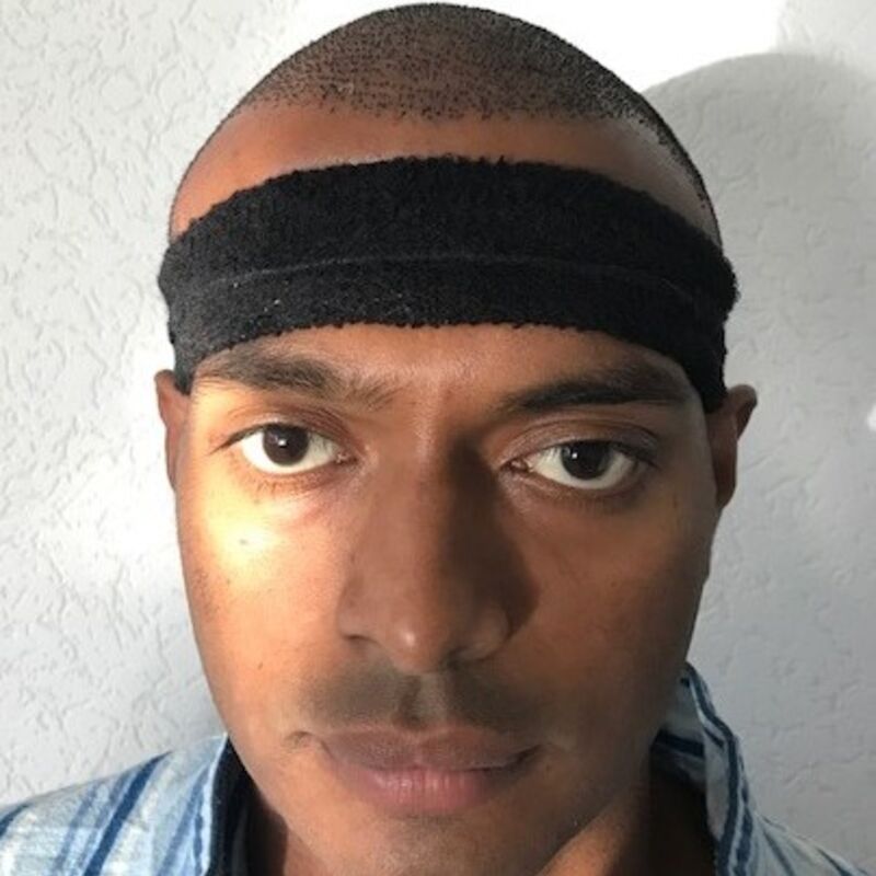 Kasan, 1/3de van kosten haartransplantatie in Nederland