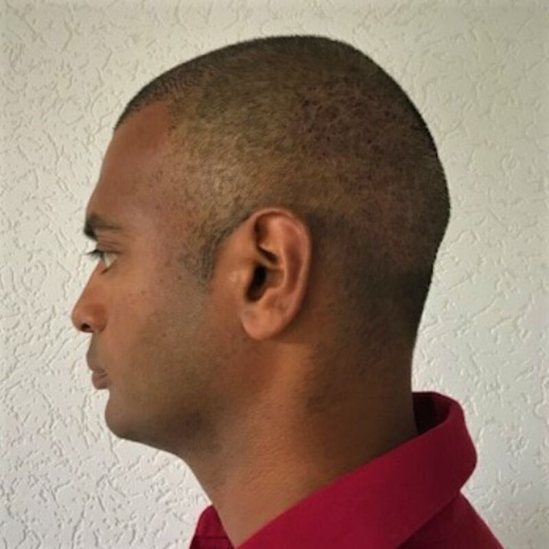 Kasan, 1/3de van kosten haartransplantatie in Nederland