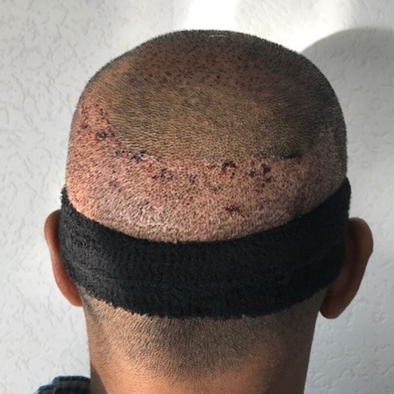 Kasan, 1/3de van kosten haartransplantatie in Nederland