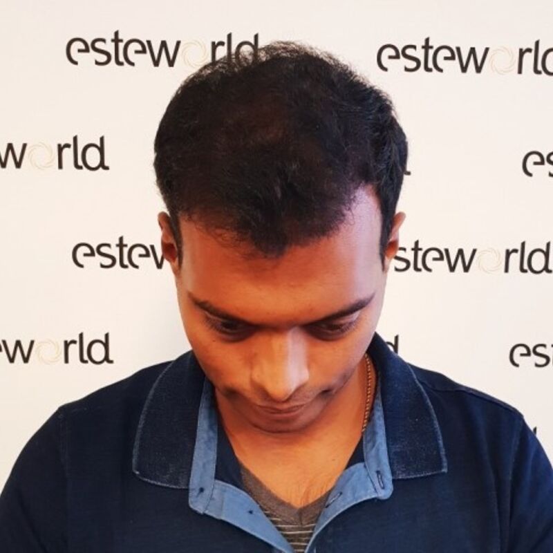 Kasan, 1/3de van kosten haartransplantatie in Nederland