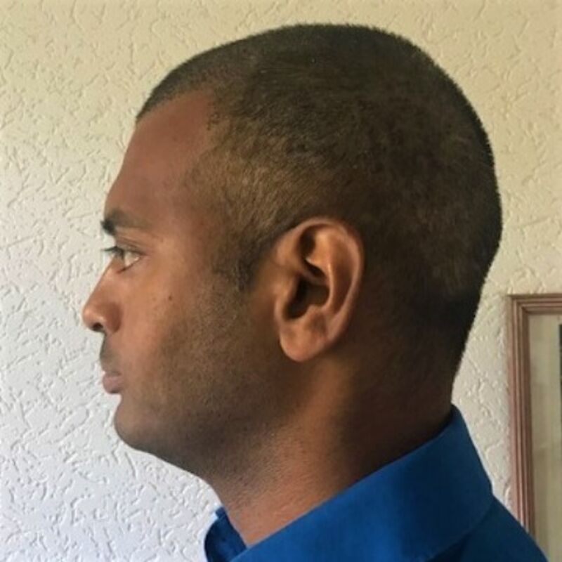 Kasan, 1/3de van kosten haartransplantatie in Nederland