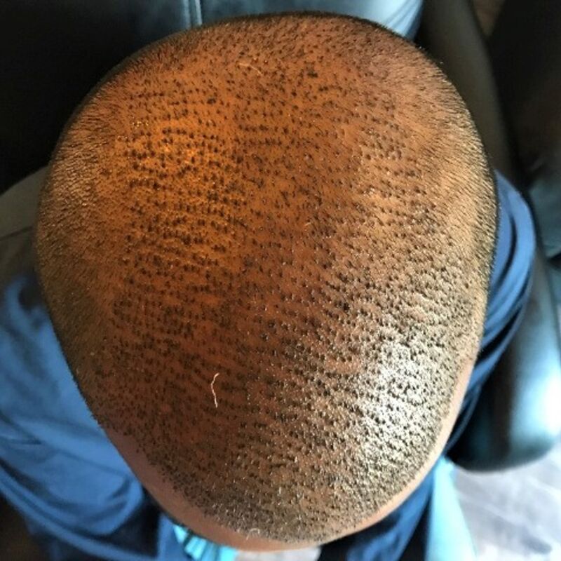 Kasan, 1/3de van kosten haartransplantatie in Nederland