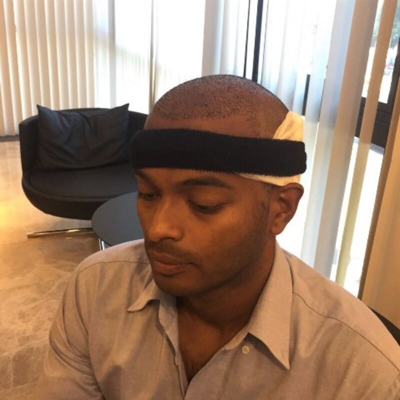 Kasan, 1/3de van kosten haartransplantatie in Nederland