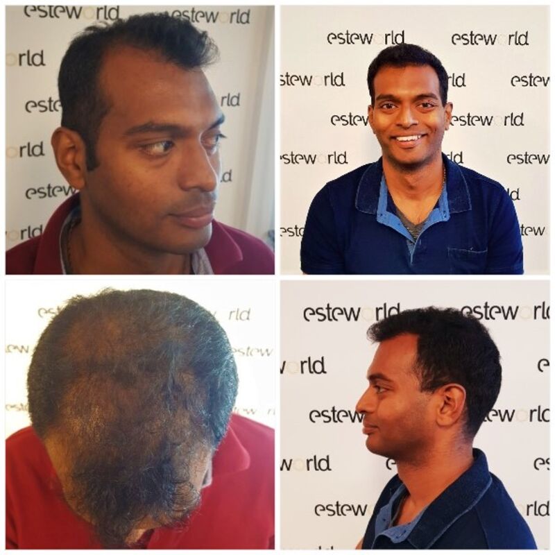 Kasan, 1/3de van kosten haartransplantatie in Nederland