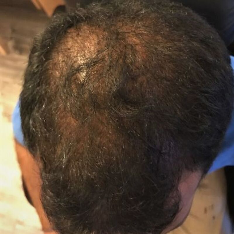 Kasan, 1/3de van kosten haartransplantatie in Nederland