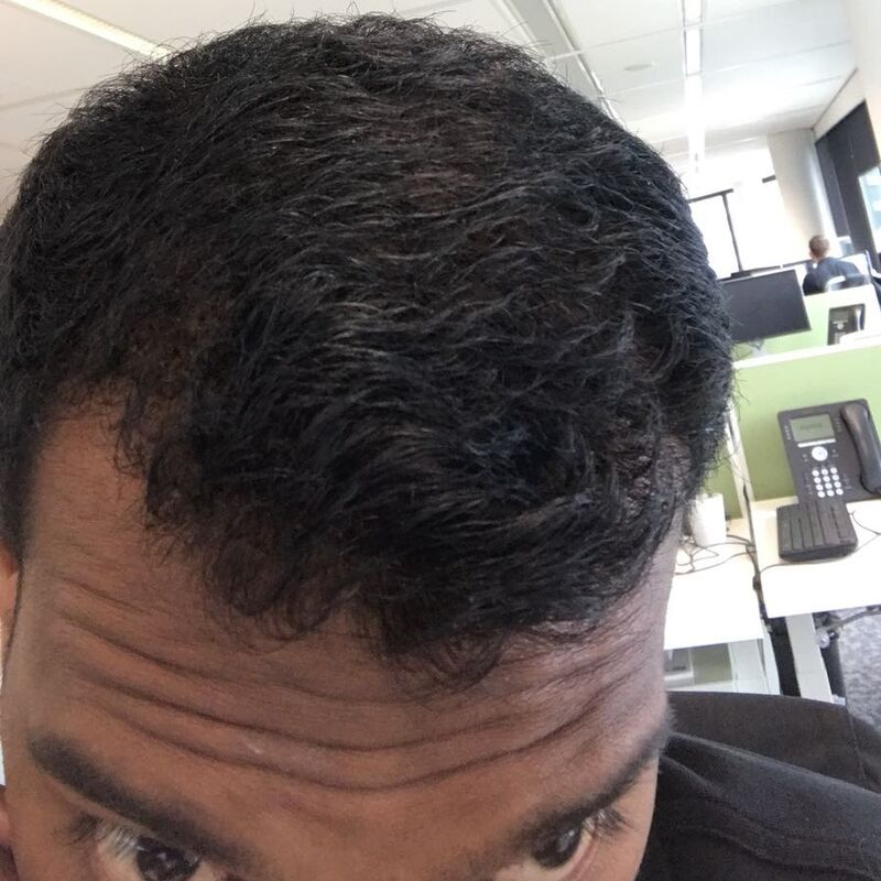 Kasan, 1/3de van kosten haartransplantatie in Nederland