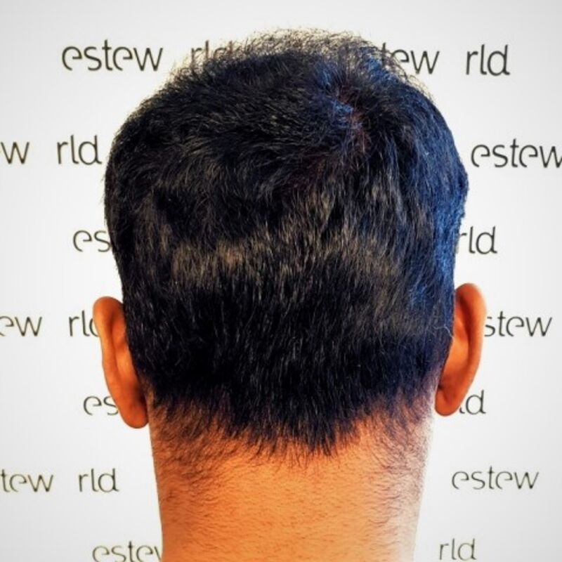 Kasan, 1/3de van kosten haartransplantatie in Nederland