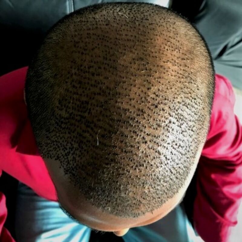 Kasan, 1/3de van kosten haartransplantatie in Nederland