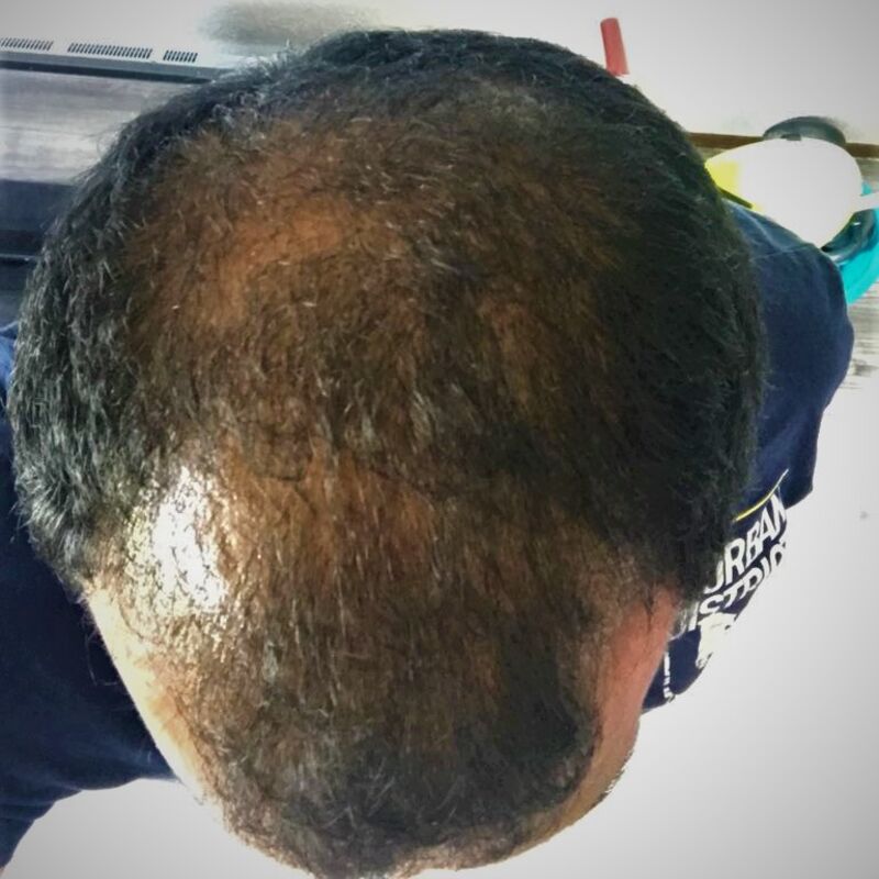 Kasan, 1/3de van kosten haartransplantatie in Nederland