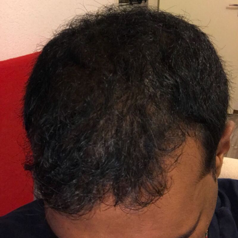 Kasan, 1/3de van kosten haartransplantatie in Nederland