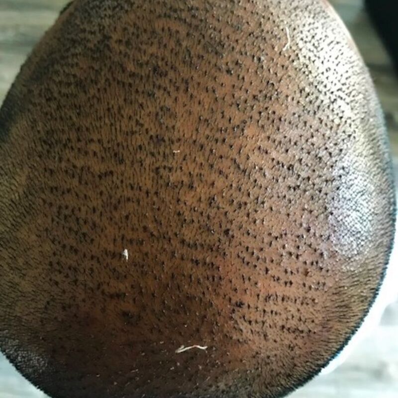 Kasan, 1/3de van kosten haartransplantatie in Nederland