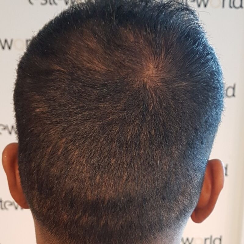 Kasan, 1/3de van kosten haartransplantatie in Nederland