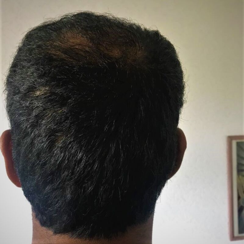 Kasan, 1/3de van kosten haartransplantatie in Nederland