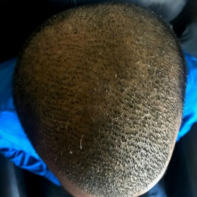 Kasan, 1/3de van kosten haartransplantatie in Nederland